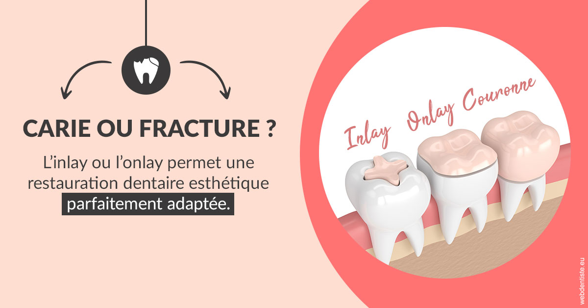 https://dr-carpentier-laurent.chirurgiens-dentistes.fr/T2 2023 - Carie ou fracture 2