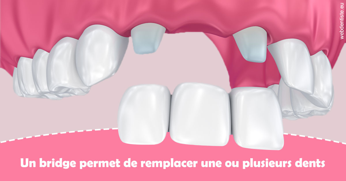 https://dr-carpentier-laurent.chirurgiens-dentistes.fr/Bridge remplacer dents 2