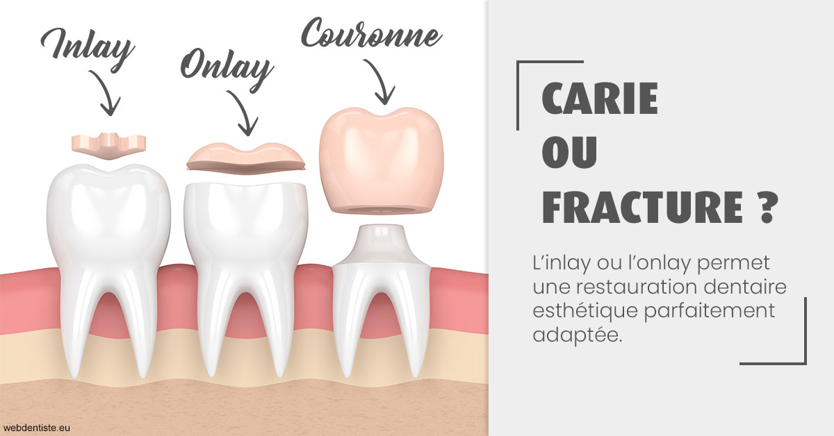 https://dr-carpentier-laurent.chirurgiens-dentistes.fr/T2 2023 - Carie ou fracture 1