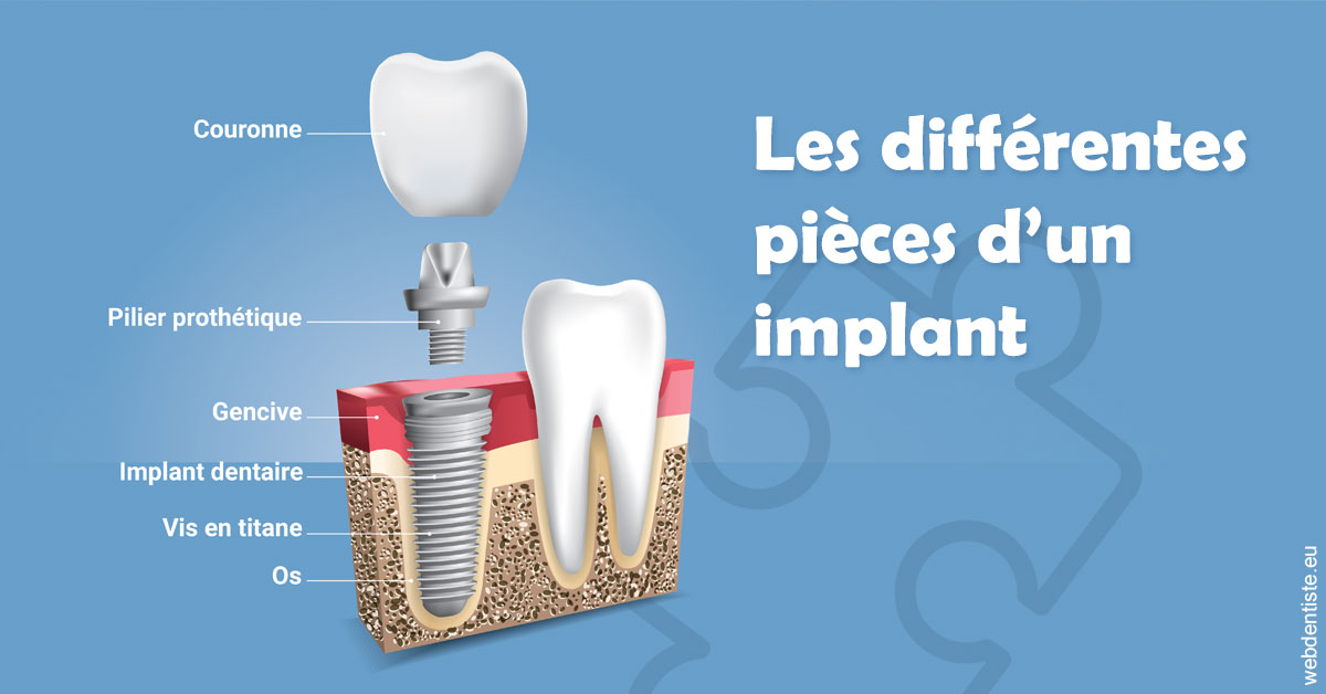 https://dr-carpentier-laurent.chirurgiens-dentistes.fr/Les différentes pièces d’un implant 1
